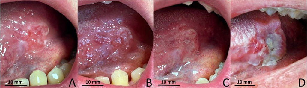 Fig. 1 Progression of the lesion: A - 03.01.2023; B - 10.01.2023; C - 30.01.2023; D - 09.02.2023.
