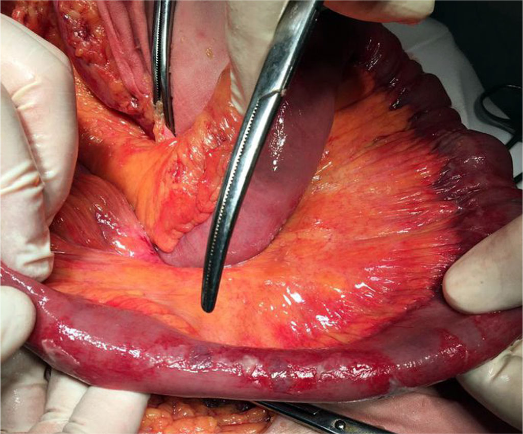 Figure 2. External view of the small intestine with decompensated enteral failure and pre-perforation changes in its wall in patients with peritonitis in the setting of COVID – 19 
