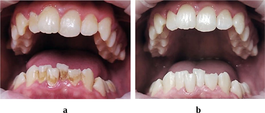 Figure 1. Patient S., 16 y.o. Abnormal ratios of dental arches (K07.2, ICD X); abnormal position of teeth (K07.3, ICD X) associated with CTD syndrome. The oral cavity hygienic status prior to (a) and after (b) AIR-FLOW MASTER PIEZON professional hygiene.