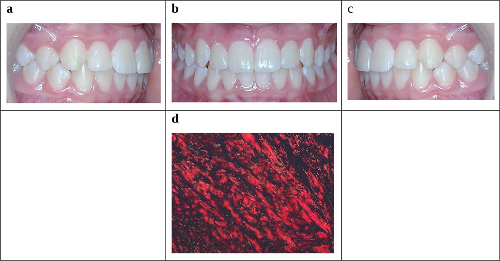 Figure 2. Patient M., 15 y.o. Clinically healthy periodontium and healthy gum (Lang, Bartold, 2018). Occlusal relationship, periodontal tissue status (a-c). Morphology of gum tissues (d) − staining with 0.1% Sirius Red F3BA solution with picric acid (×500).