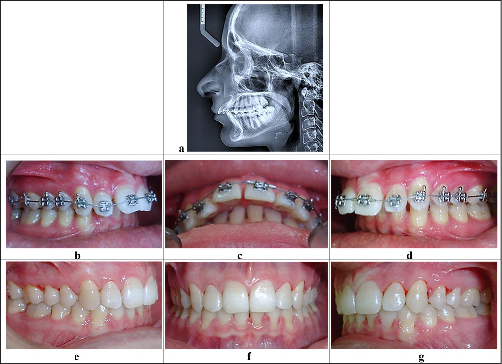 Figure 3. Patient E., 16 y.o. Diagnosis: chronic catarrhal gingivitis, moderate severity (K 05.10). Distal occlusion (closure of first molars and canines, Angle’s Class II; 07.20), protrusion of the upper front teeth. Teleroentgenogram, lateral projection (a), periodontological status and occlusive relationships prior to (b-d) and after (d-g) the orthodontic treatment.
