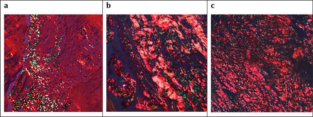 Figure 4. Morphological picture of gum tissue in patient E., 16 y.o., with chronic catarrhal gingivitis, moderate severity (K05.10): a – initial status; b – status after conservative anti-inflammatory therapy; c – status after complex dental treatment. Staining with 0.1% SiriusRed F3 BA solution with picric acid (=500).