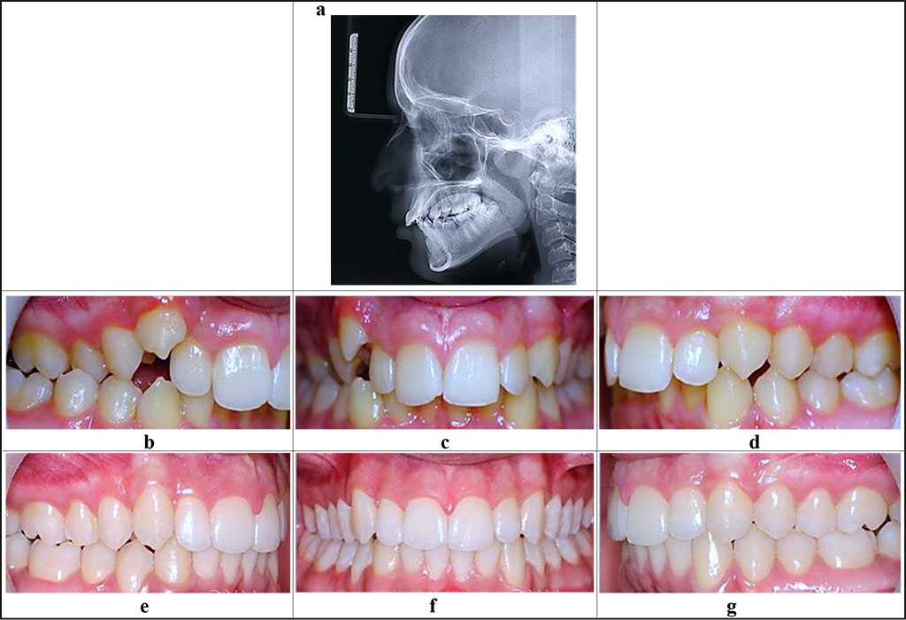 Figure 5. Patient S., 15 y.o. Diagnosis: chronic catarrhal gingivitis, moderate (K 05.10). Deep distal bite (K 07.20), cross bite on the right (K07.25), upper canine dystopia on the right (K07.3). Teleroentgenogram, lateral projection (a), the periodontological status and occlusive relationships before (b-d) and after (d-g) the orthodontic treatment.