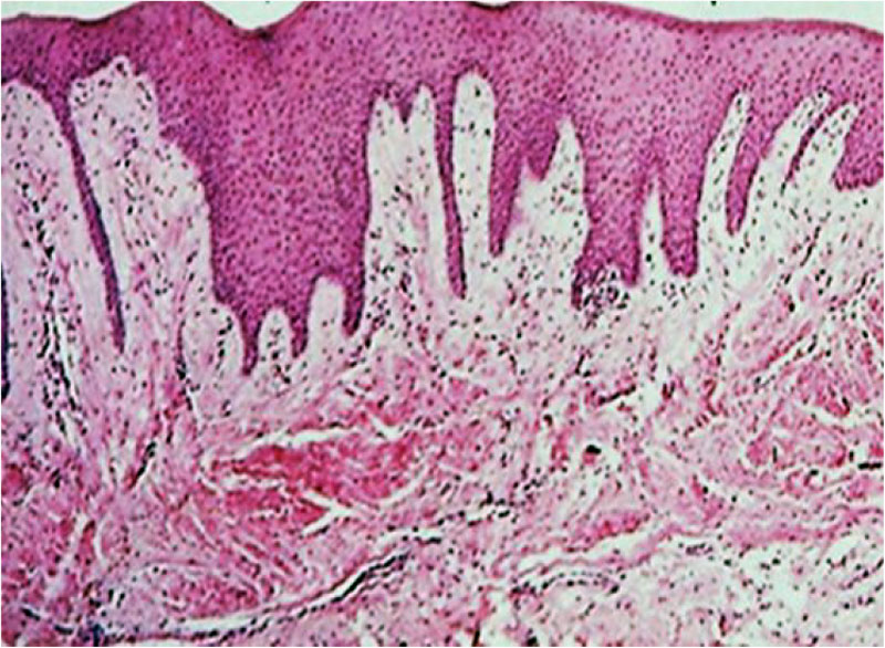 Figure 6. Morphological picture of gum tissue in patient S., 15 y.o., with deep distal bite (K07.20): a – initial status; b – status after conservative anti-inflammatory therapy; c – status following comprehensive dental treatment. Staining with 0.1% SiriusRed F3BA solution with picric acid (=500).