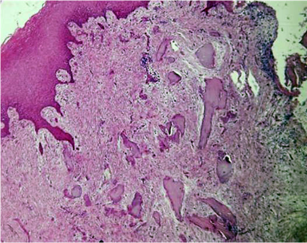 Figure 8. Gum biopsy histological preparation in a patient of Subgroup 1, following comprehensive dental treatment. Staining with hematoxylin-eosin (×100).