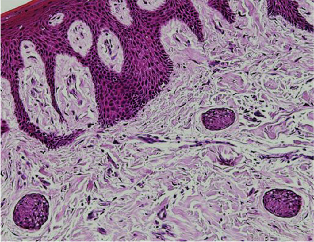 Figure 9. Gum biopsy histological preparation, patient of Subgroup 1, following comprehensive dental treatment. Staining with hematoxylin-eosin (×100).