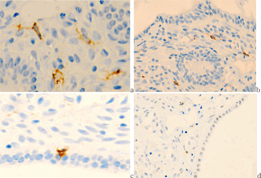 Fig.2 - Cervix mucosa of 56 years old patient. a) exocervix (CD8); b) transformation zone (CD8); c) endocervix (CD68); d) CD163.Immune histochemistry to detect localization of CD4, CD8, CD68 with prestaining haematoxylin-eosin. Microphoto. Zoom a, c) x400; b, d) x 200.