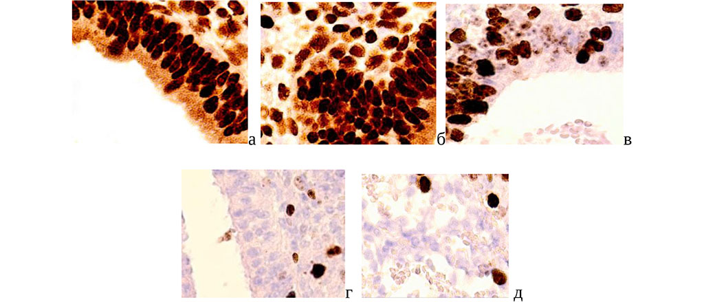 Figure 1. Cervical mucosa of postmenopausal women. A, b) with a severe course; c, d) with a normal course. Immune histochemistry to detect the localization of receptors for sex hormones with additional staining with hematoxylin. (a, b, c – progesterone receptors; d, e – estrogen receptors). Magnification x400.