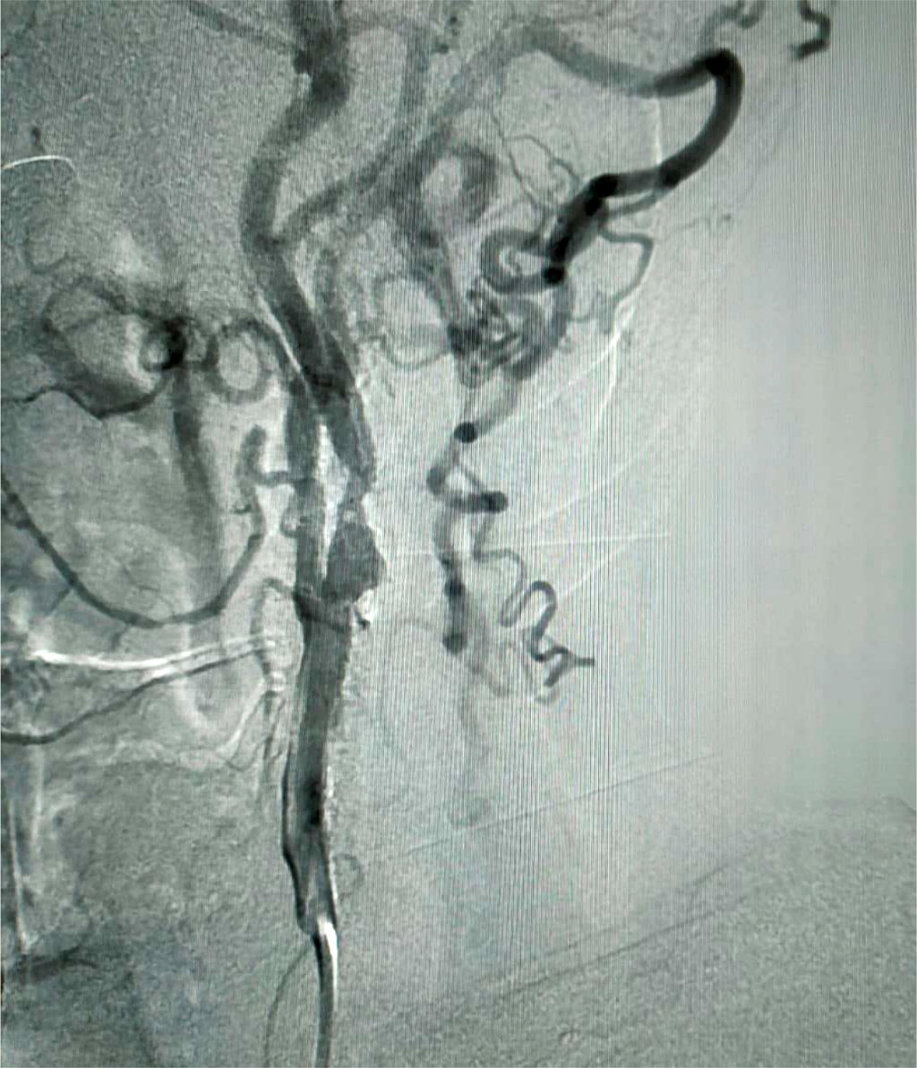 Fig. 1. Carotid angiography. Stenosis of the internal carotid artery on the left (91%), visible collaterals