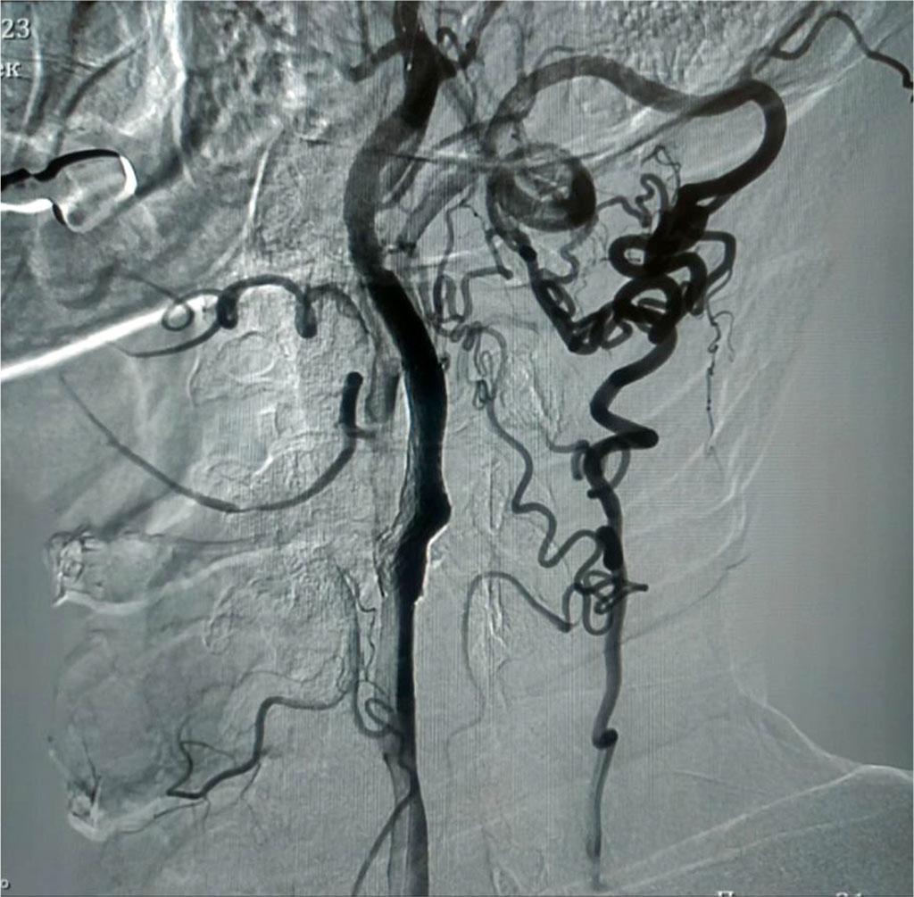 Fig. 2. Carotid angiography. Condition after x-ray-guided endovascular stenting of the internal carotid artery on the left.