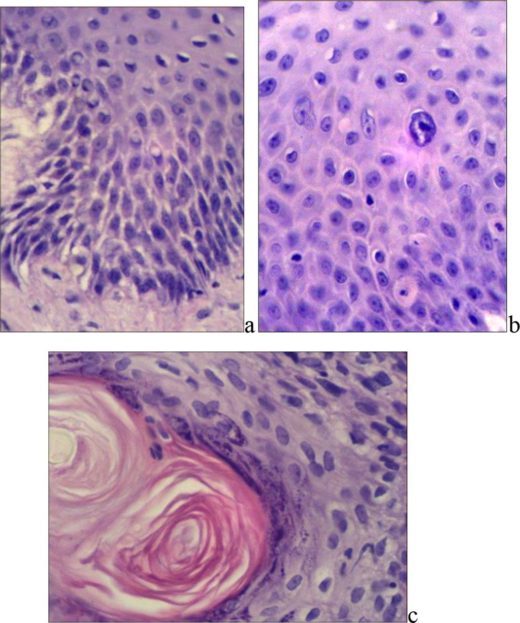 Fig. 1. Differentiated VIN: a) and b) – increased number of prematurely differentiated keratinocytes (staining with hematoxylin and eosin); c) – hyperkeratosis, formation of horny pearls (X400, b) – X600).