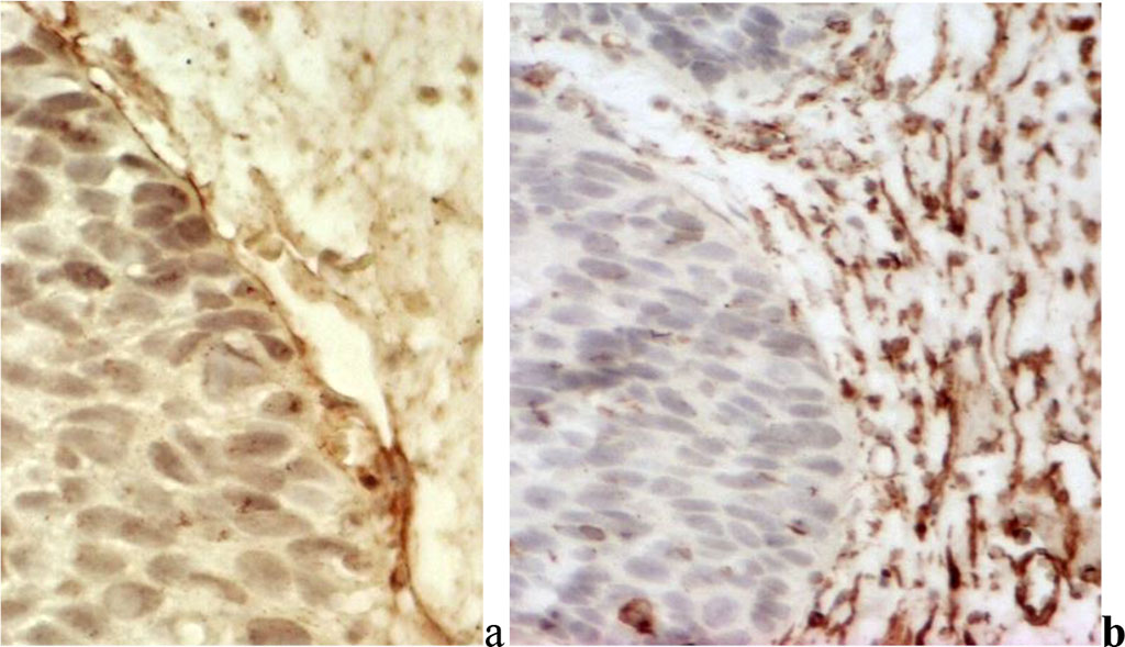 Fig. 2. Differentiated vulvar intraepithelial neoplasia: a) in the basement membrane there is clear intensive expression of type IV collagen; b) a developed subbasal network of microcirculatory vessels is detected;