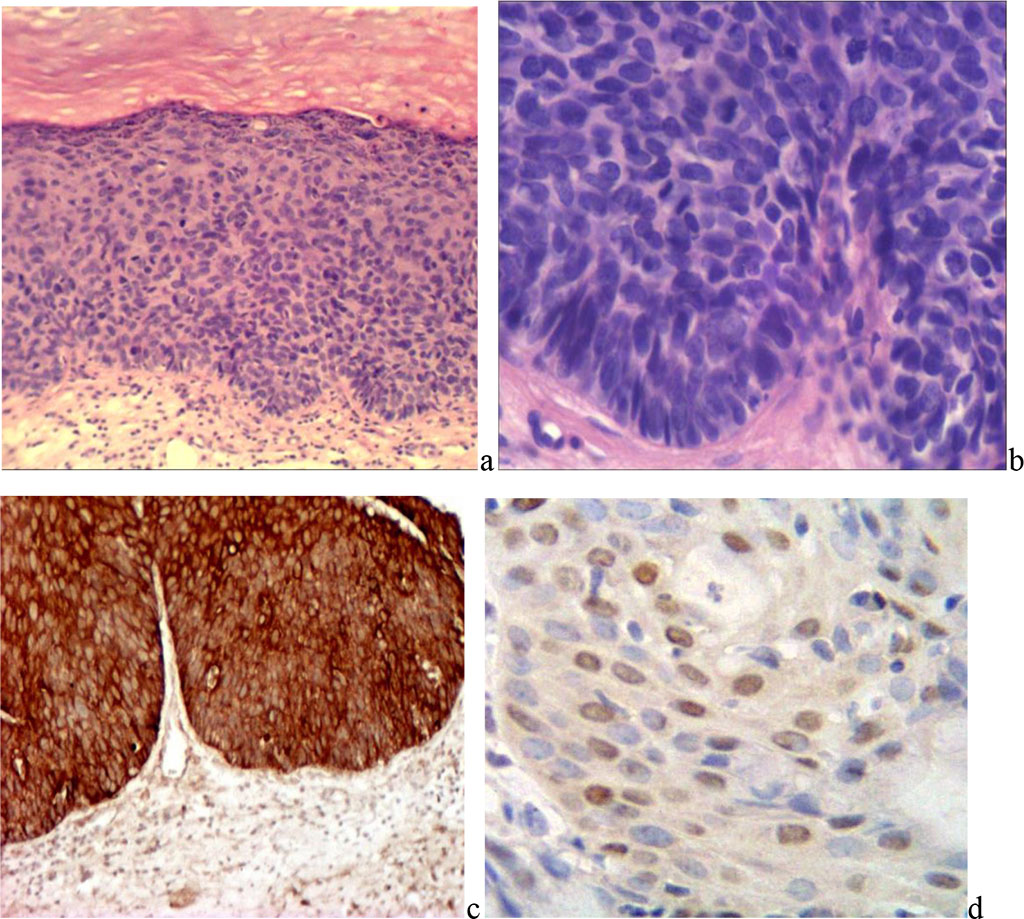 Fig. 3. Vulvar intraepithelial neoplasia: a) mild X200; b) severe X400; c) positive reaction of epithelial cells to pancytokeratin. d) with PCNA MAB X400;