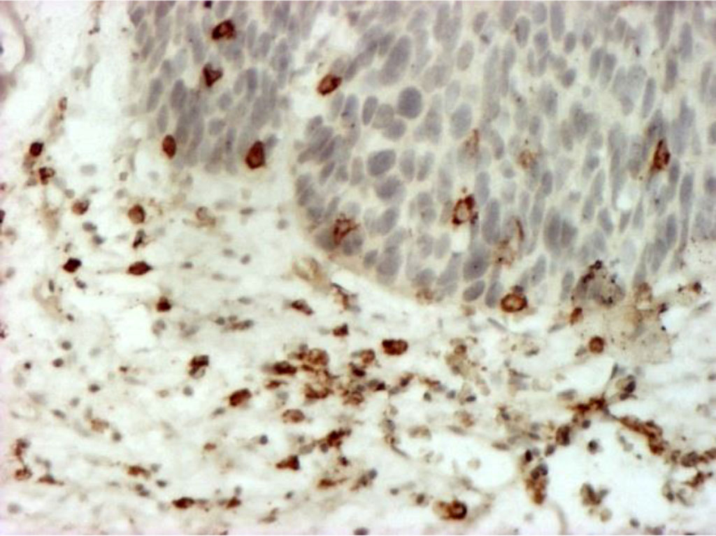 Fig. 4. Stromal lymphocytes (T-helpers) (CD4+), forming small clusters in places. Immunohistochemical staining with MAb to CD4+ X400.