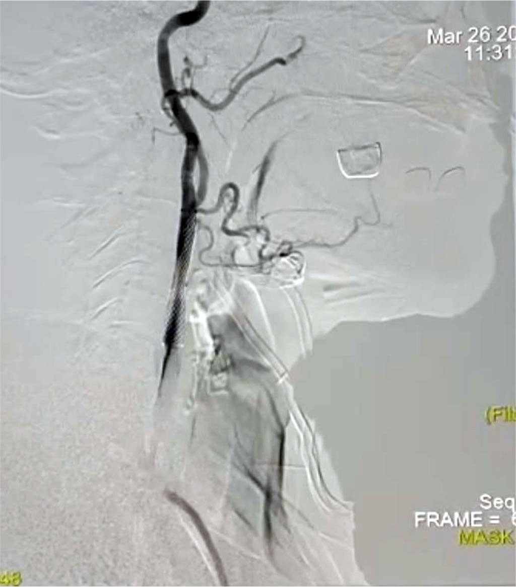 Fig. 2. Subclavian steal syndrome, stenosis of the left subclavian artery 