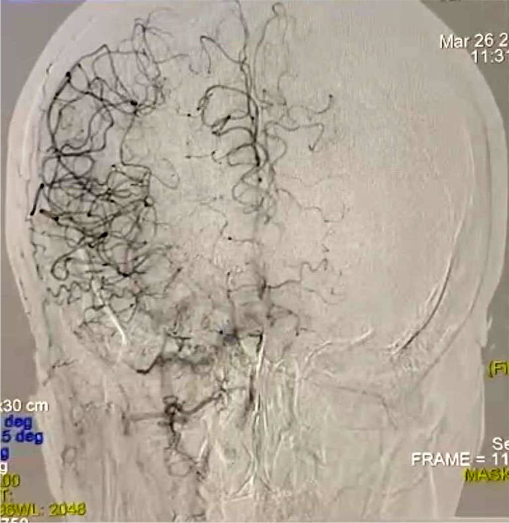 Fig. 3. Lack of blood supply in the left hemisphere