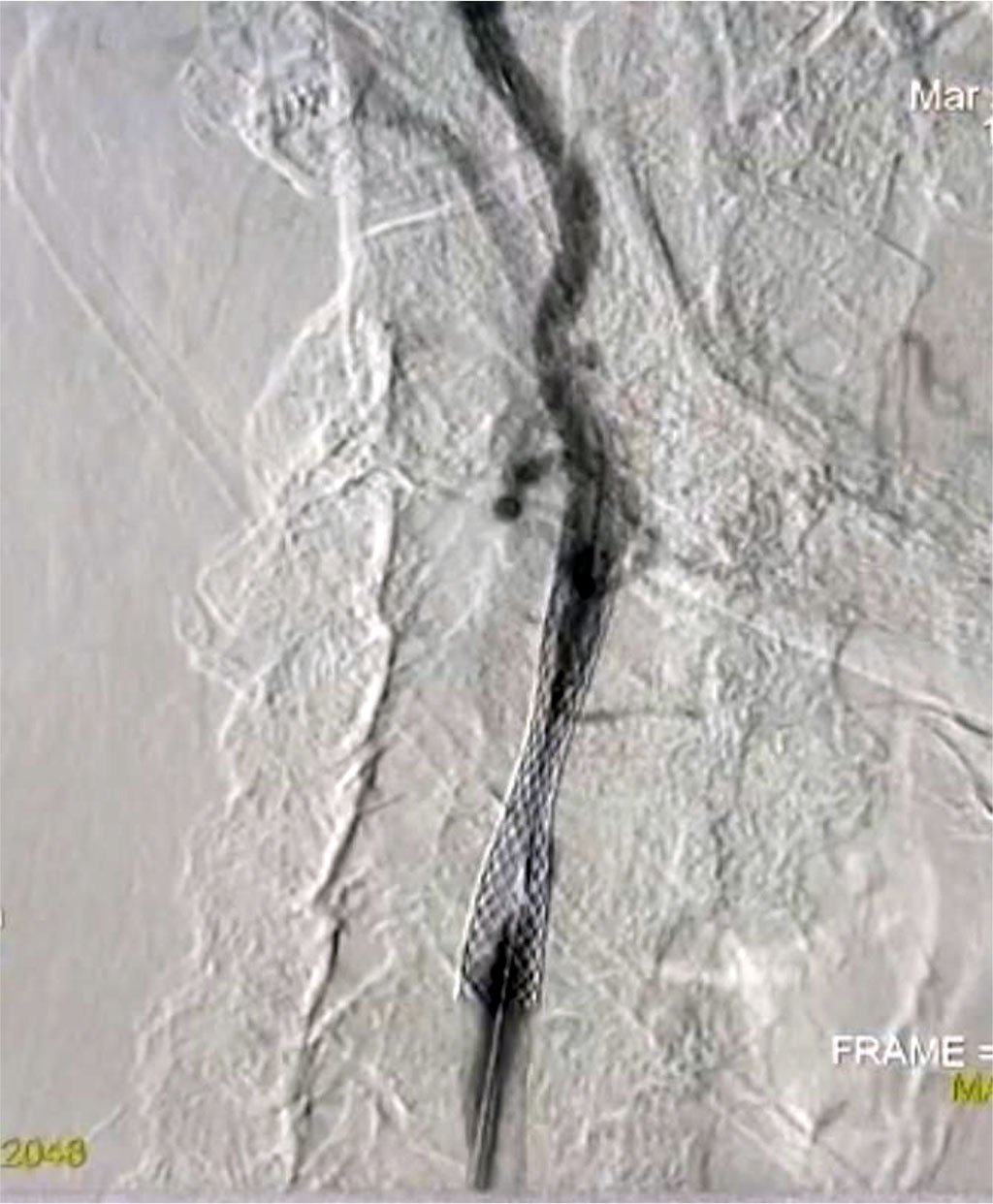 Fig. 4. Stenting of the left subclavian artery