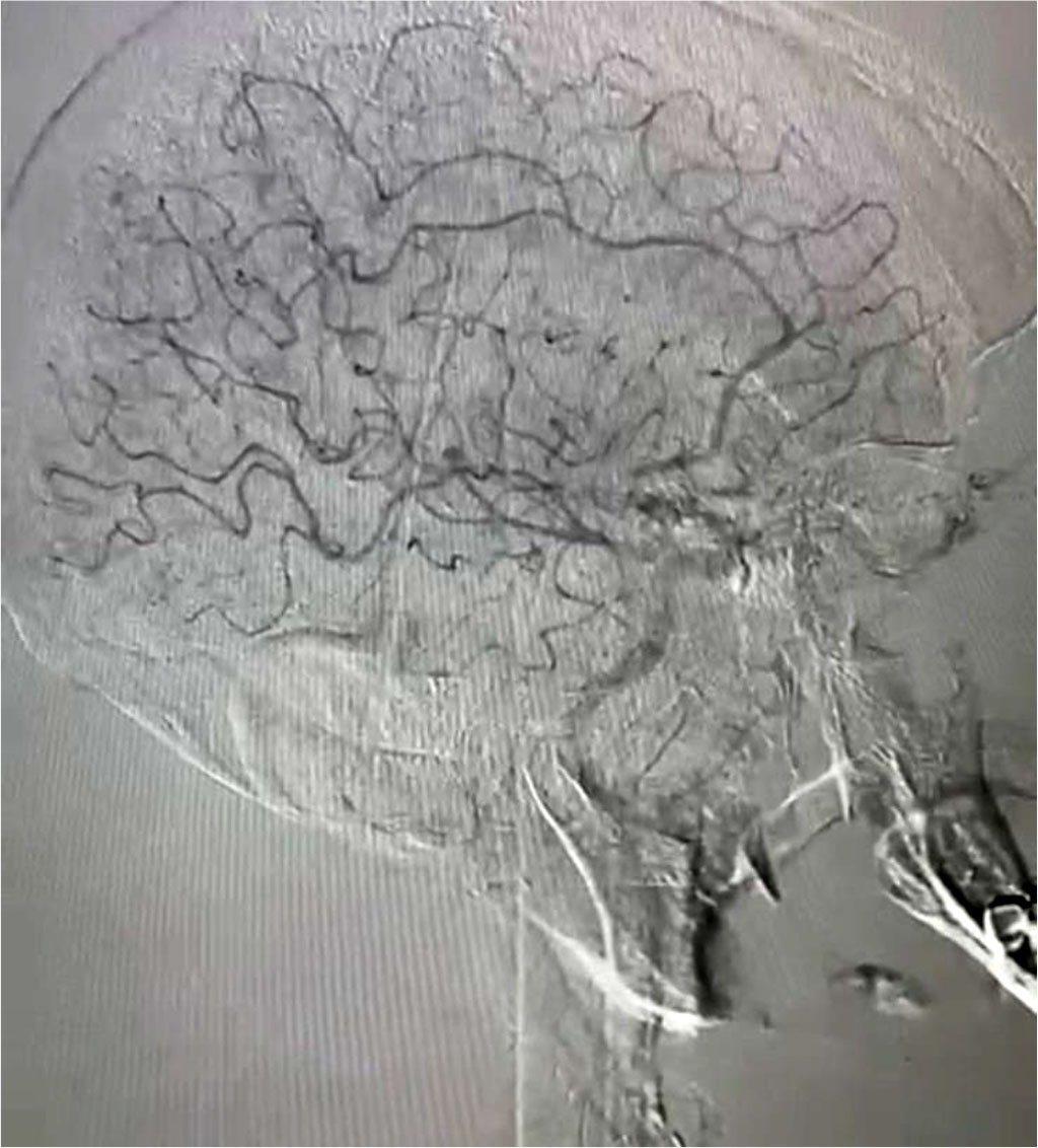 Fig. 5. Restoration of blood flow in the left hemisphere