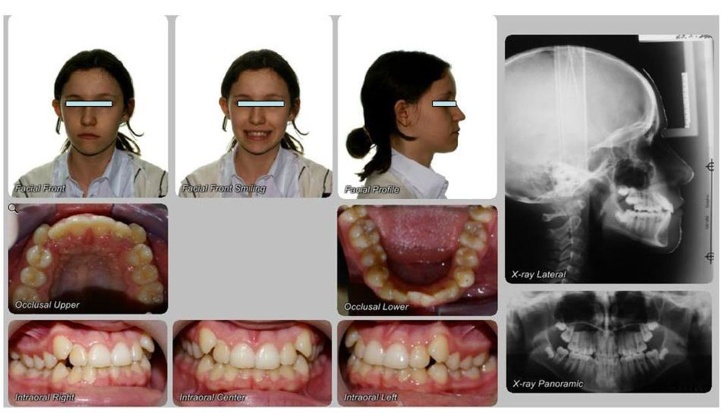 Fig. 1 Clinical and radiographic view of 11-year-old girl’ dentition before treatment. 