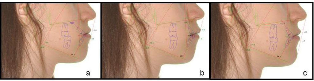 Fig 2 Comparison of profile photos while making treatment forecast. a - before treatment; b – treatment forecast with expansion of jaws – profile deterioration; c - treatment prediction with extraction of four premolars - profile improvement.