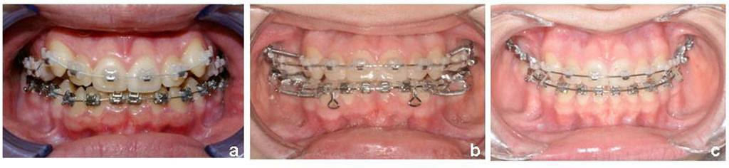 Fig. 3 Stages of orthodontic treatment.