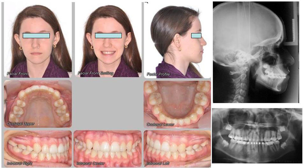 Fig. 4 Clinical and radiographic view of a 13-year-old female patient's post-treatment dentition.