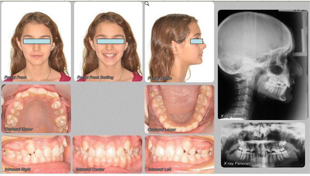 Fig.5 Clinical and radiographic view of 13-year-old girl's dentition before treatment. 