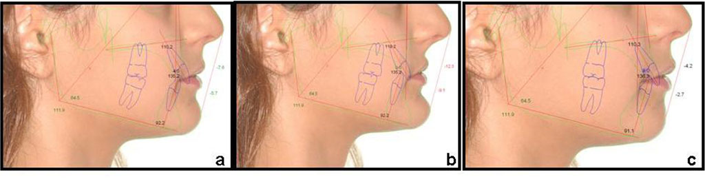 Fig. 6 Comparison of 13-year-old female patient’s photos during treatment outcomes prediction. A – before treatment; b – treatment simulation with extractions indicates potential profile deterioration; c – treatment simulation with jaw expansion demonstrates potential profile improvement