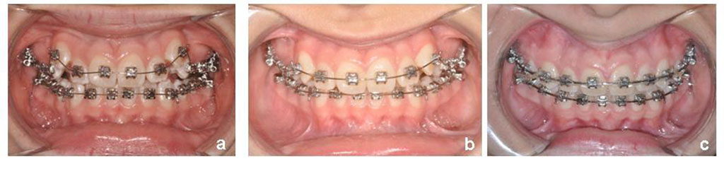 Fig.7 Progression of leveling and formation of multiple occlusal contacts. 