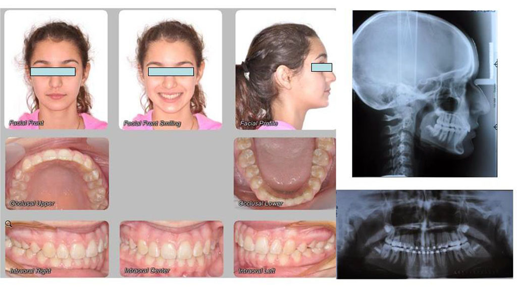 Fig.8 Clinical and radiographic view of 1year post-treatment dentition.