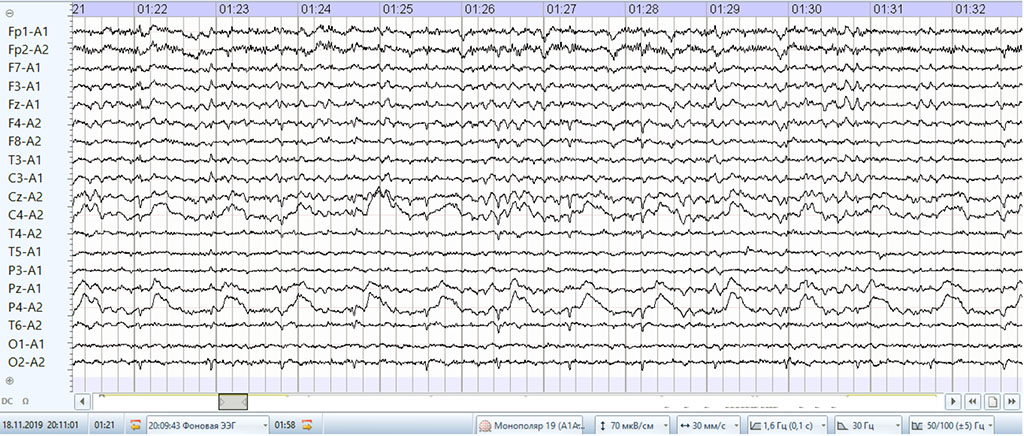 Fig. 5. Baseline EEG in amnestic aphasia (explanations in the text).