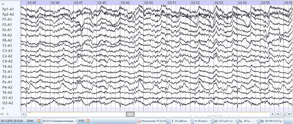Fig. 6. EEG hyperventilation in amnestic aphasia.