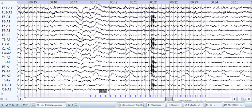 Fig. 7. EEG with photic stimulation in amnestic aphasia.