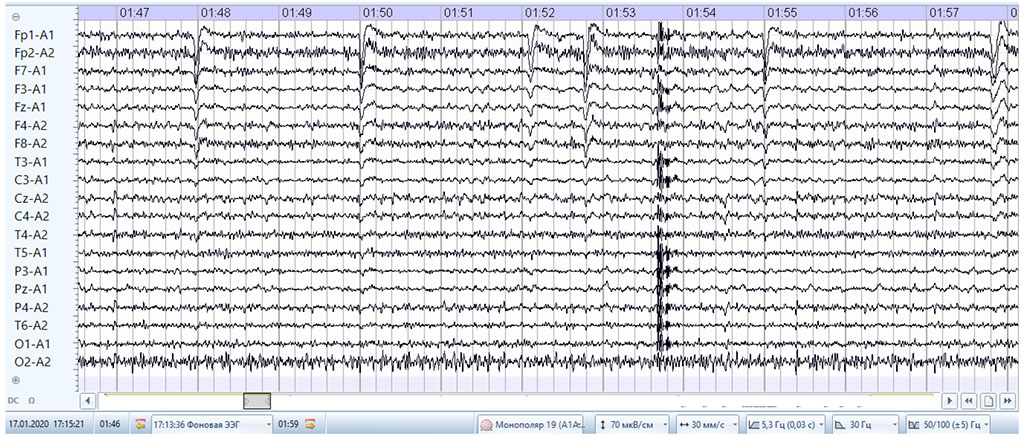 Fig. 8. Baseline EEG during the treatment of amnestic aphasia (explanations in the text).