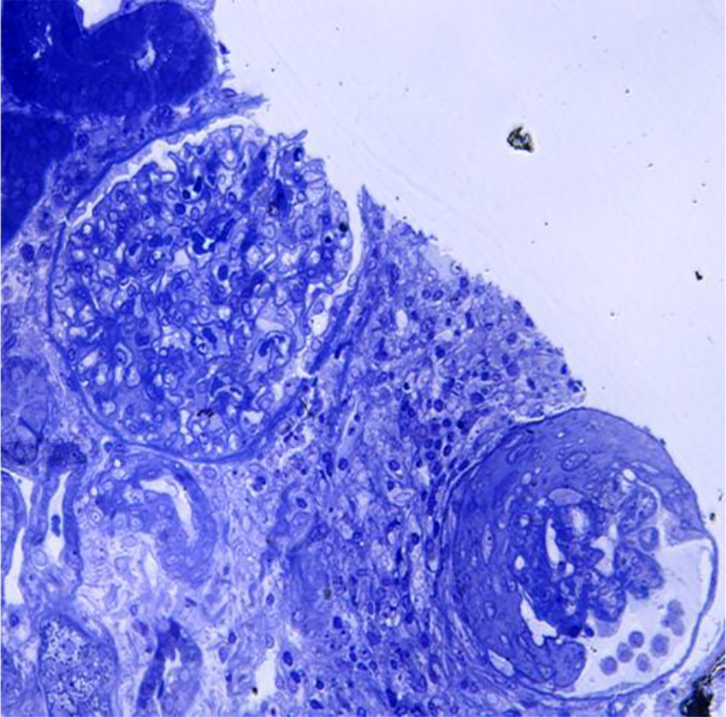 Figure 2. Light microscopy- glomerular sclerosis; periglomerular lymphoplasmocytic inflammation 