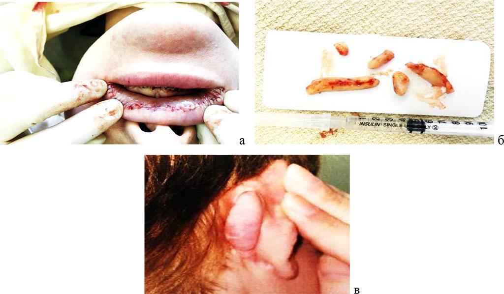 Figure 3 - A) scarring after correction in the zone of the red border of the lips. B) Implants extracted from the lips. C) Keloid scars after otoplasty.