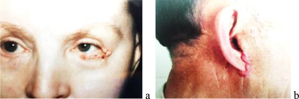 Figure 1. A) Eyelid surgery of a woman. B) Keloid scar in the area of the auricle of a man.