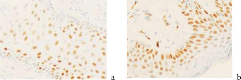 Figure 11 - Localization of cells expressing VEGF in the scar structure. immune histochemistry. Magnification a, b, c x200.