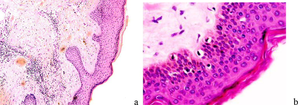 Figure 2 - normal skin. Stained with hematoxylin and eosin. Magnification A) x100; b) x400.