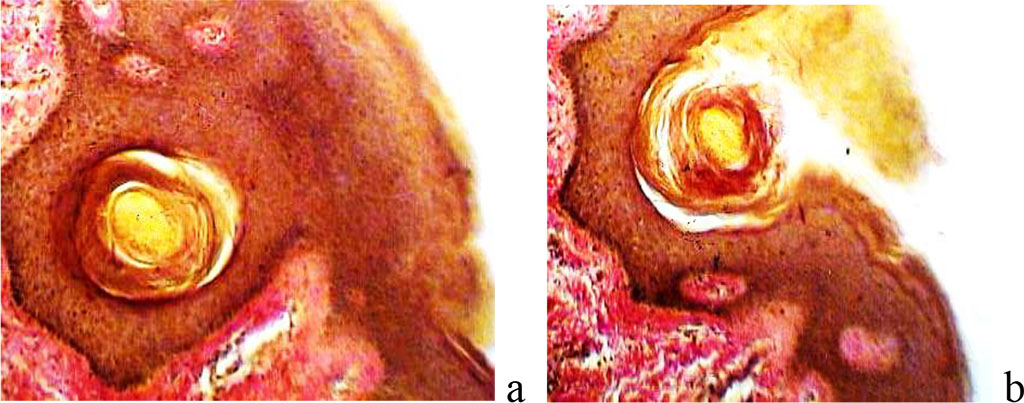Figure 4 - The wound surface of the skin: a - the prickly layer of the epidermis is normal; b: spiny layer of the epidermis with scarring - intercellular boundaries are not identified. Magnification x 200. Staining with hematoxylin.
