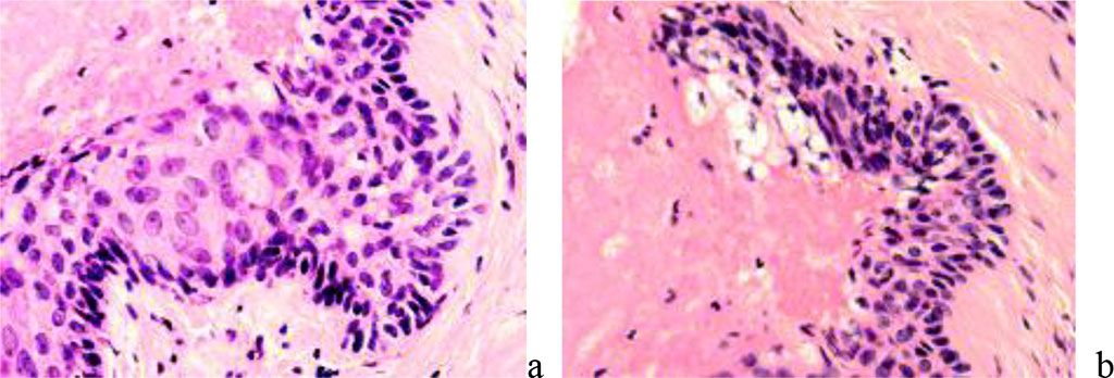 Figure 6 - reparative regeneration of the skin with the germination of the epidermis under the necrotic wound area. Staining: a) with hematoxylin and eosin. Magnification x200.