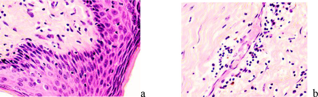 Figure 7 - Papillary and reticular layers of the dermis under conditions of reparative regeneration of the skin in the neck area: a - regeneration area of a hypertrophic scar; b – area of keloid scar formation. Stained with hematoxylin and eosin. Magnification x 200.