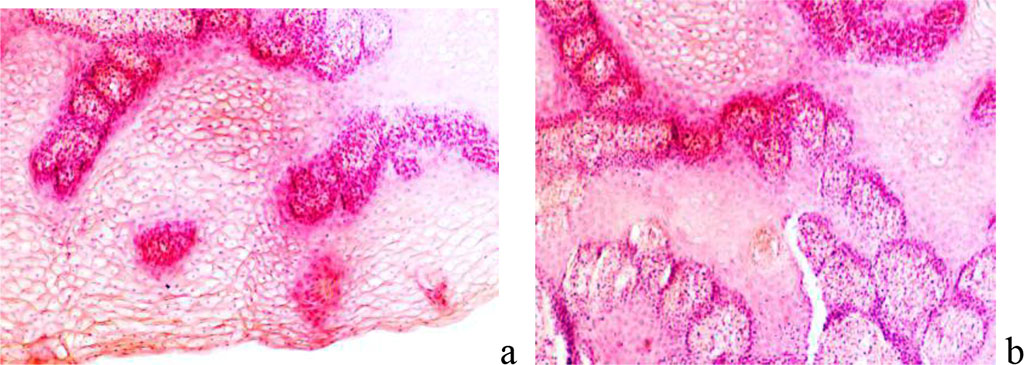 Figure 8 - Epidermis of the skin with keloid scars: a - earlobe; b – breast skin after correction. Stained with hematoxylin and eosin. Magnification x 200.