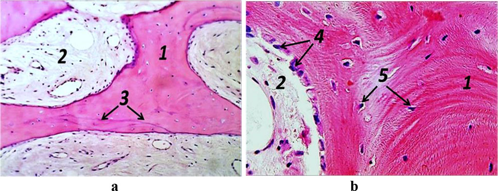 Figure 10. Histological preparation, patient R., 51 y.o.; hematoxylin-eosin stain; a – magnification (×250); b − magnification (×500); 1− bone trabeculae; 2 − red bone marrow; 3 – bonding lines; 4 – osteogenic cells; 5 – osteocytes.