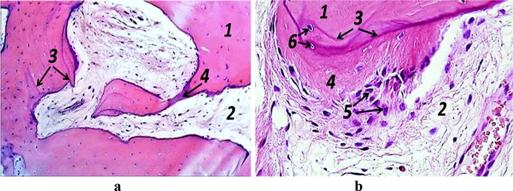 Figure 11. Histological preparation, patient S., 62 y.o.; hematoxylin-eosin staining; a – magnification (×250); b − magnification (×500); 1− bone trabeculae; 2 − red bone marrow; 3 – bonding lines; 4 – osteoid; 5 – osteogenic cells, 6 – osteocytes.
