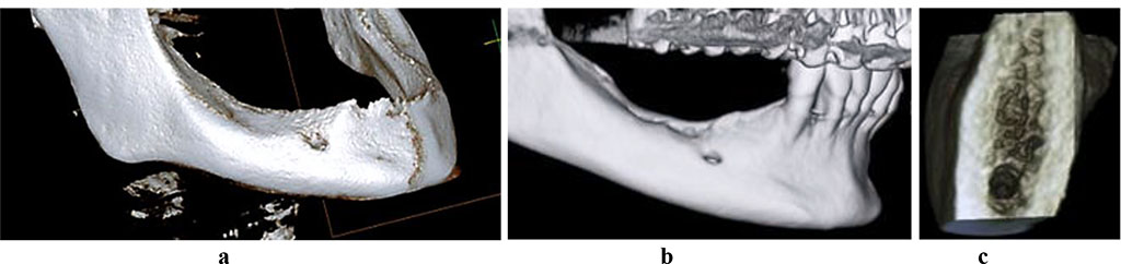 Figure 2. 3D-reconstruction of the mandible with a full (a) and a partial (b) adentia, 3D cross-section of the mandible alveolar part, with neither osteoporosis nor osteopenia observed (c).