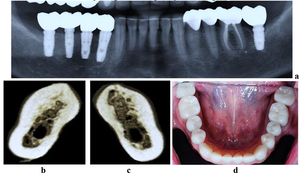 Figure 4. Patient M., 53 y.o. Diagnosis: mandible partial adentia, Class I by Kennedy. Lower jaw CBCT: a – the bone tissue volume 12 months after the dental implant installation (panoramic reformat); 3D cross-sections at the missing teeth area 3.7 (b) and 4.6 (c) prior to the installation of dental implants; d – the lower dentition after implant and prosthetic treatment.