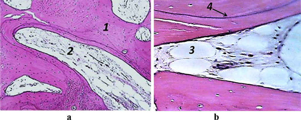 Figure 5. Histological preparation, Patient M., 53 y.o., hematoxylin-eosin staining; a – magnification (×250); b − magnification (×500); 1− bone trabeculae, 2 − red bone marrow, 3 – adipose tissue, 4 – resorption lacuna.