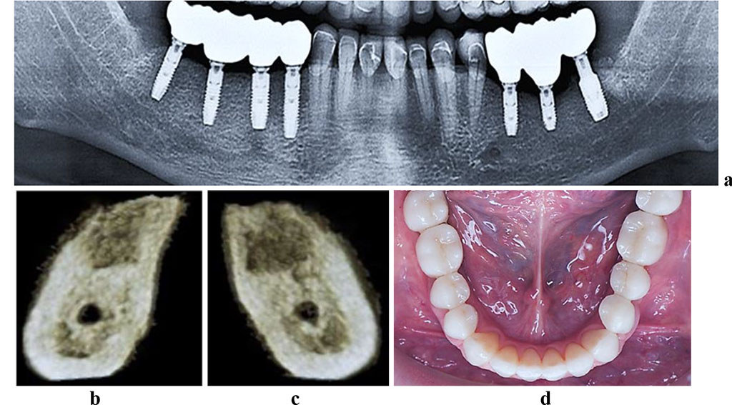 Figure 6. Patient K., 57 y.o. Diagnosis: lower jaw partial adentia; Class I by Kennedy. Lower jaw CBCT: a – bone tissue 12 months following the installation of dental implants (panoramic reformat); 3D cross-sections at the adentia area 3.6 (b) and 4.6 (c) prior to the installation of dental implants; d – lower dentition after implantological and prosthetic treatment.