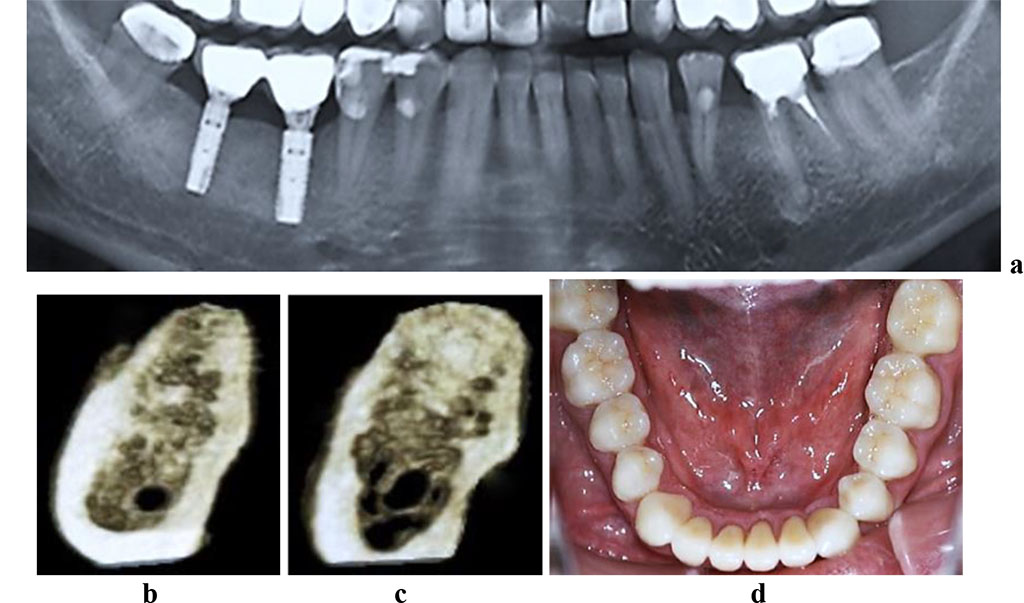 Figure 7. Patient R., 51 y.o. Diagnosis: lower jaw partial adentia; Class III by Kennedy. Lower jaw CBCT: a – bone tissue 12 months following the installation of dental implants (panoramic reformat); 3D cross-sections at the adentia area 3.7 (b) and 3.6 (c) prior to the installation of dental implants; d – lower dentition after implantological and prosthetic treatment.